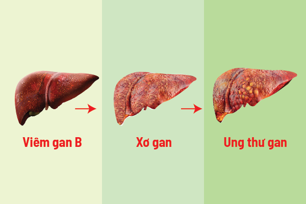 Viêm gan B có thể diễn tiến thành xơ gan, ung thư gan