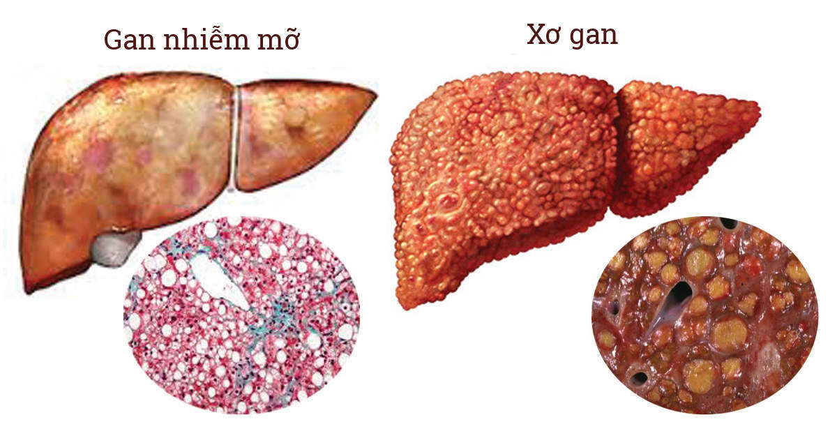 Xơ gan đặc trưng bởi sự hình thành các mô sẹo trong gan