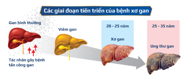 Xơ gan có thể tiến triển nặng thành ung thư gan