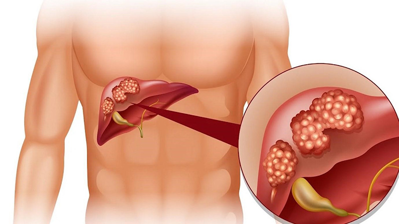 Viêm gan B dẫn đến tổn thương gan, có thể nhiễm bệnh suốt đời