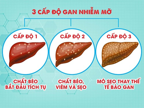 Gan nhiễm mỡ cấp độ 1 là gì?