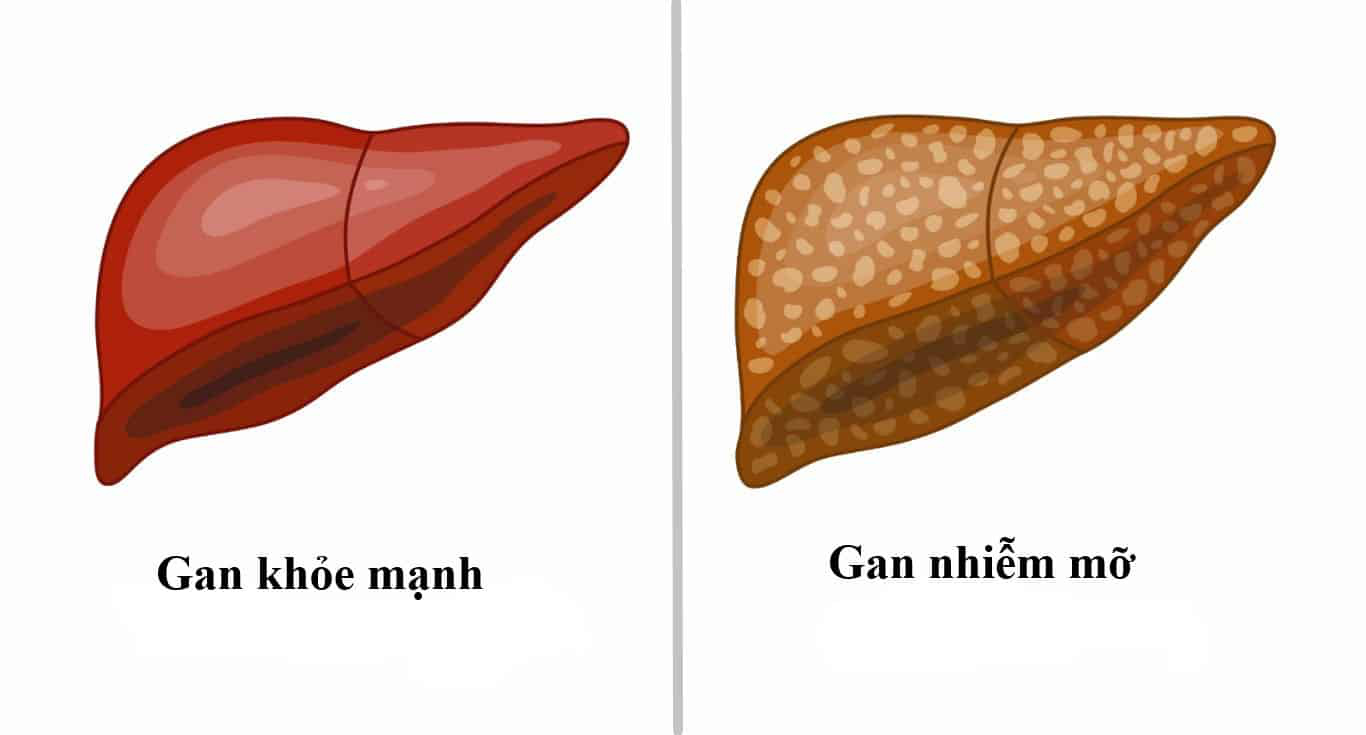 Gan nhiễm mỡ độ 3: Mức độ nguy hiểm, nguyên nhân, triệu chứng và phương pháp điều trị