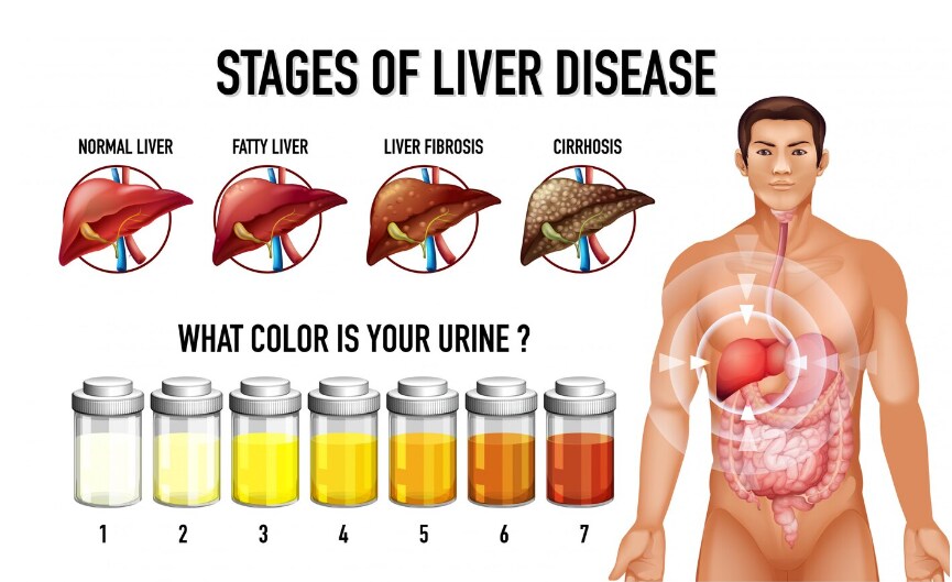 Nước tiểu sẫm màu có thể là dấu hiệu của bệnh viêm gan