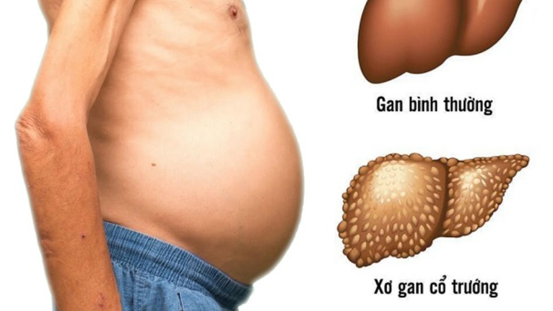 Xơ gan cổ trướng là bệnh gì? Những điều cần biết về bệnh