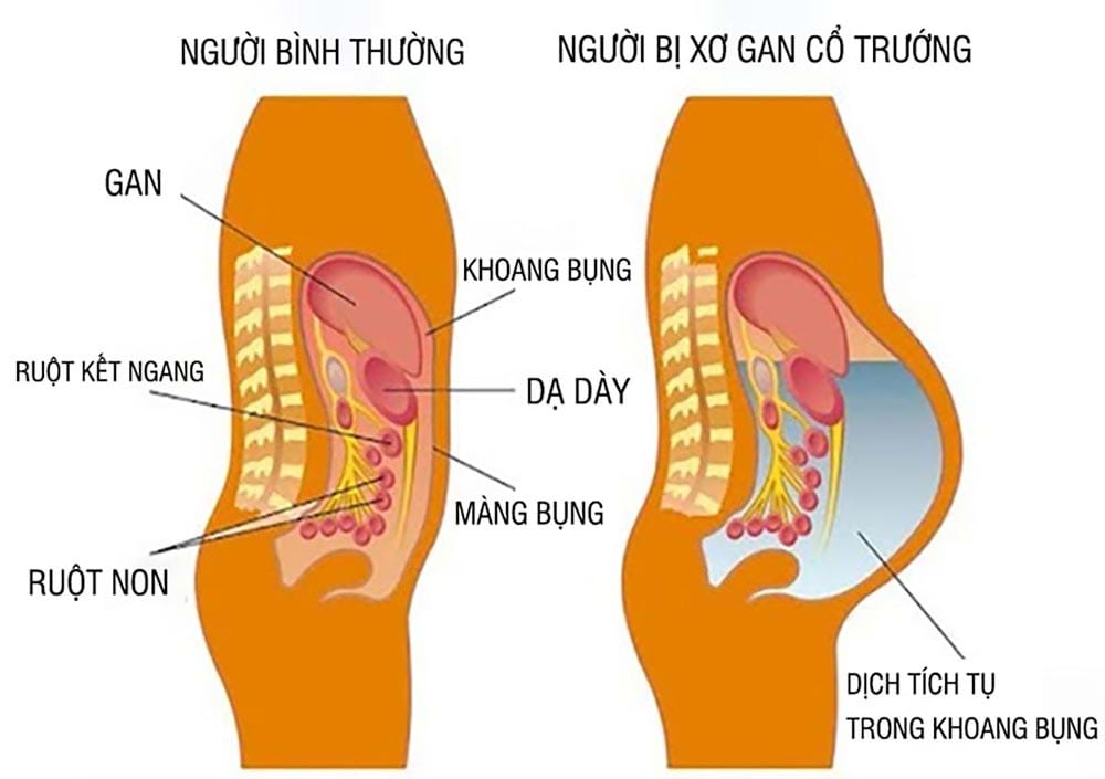 Xơ gan gây biến chứng cổ chướng, phù nề