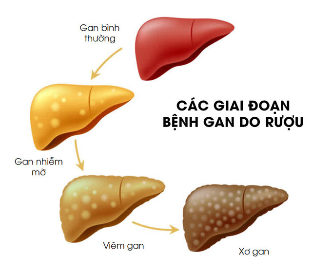 Rượu bia gây ra các bệnh về gan mật nghiêm trọng