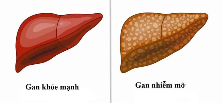 Khi gan còn khả năng bù trừ thì các triệu chứng bệnh gan không rõ rệt