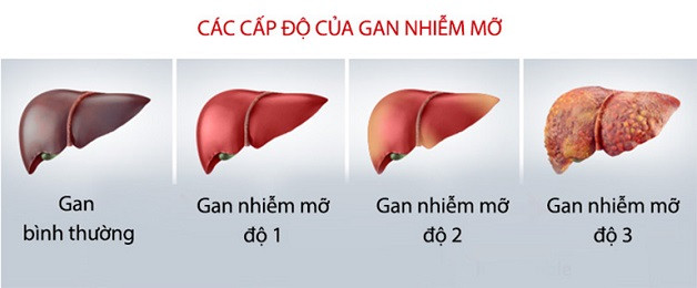 Thế nào là gan nhiễm mỡ độ 3?